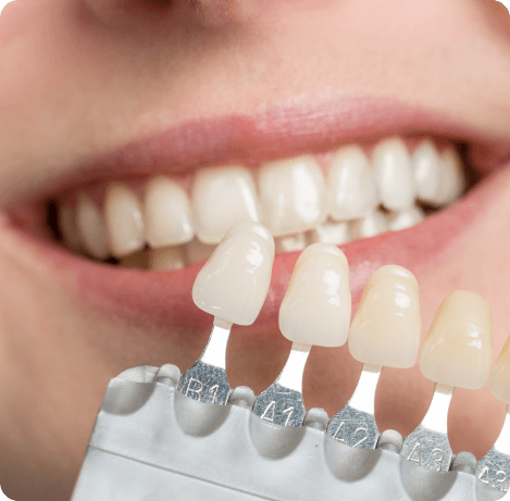 Close up of row of dental veneers in front of smile