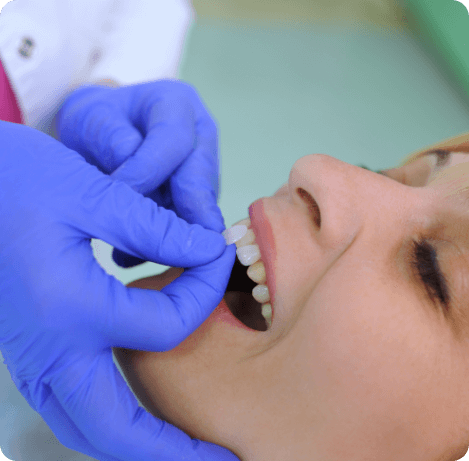 Dentist placing veneer over a tooth