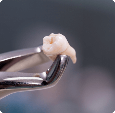 Dental forceps holding extracted tooth