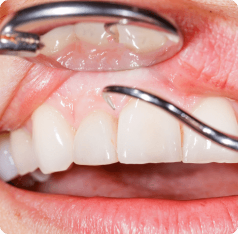 Close up of dental instruments examining the gums