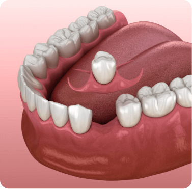 Animated dental crown being placed in area of mouth with one missing tooth