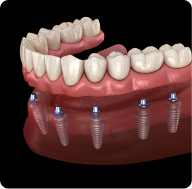 Animated implant denture replacing a whole row of missing teeth