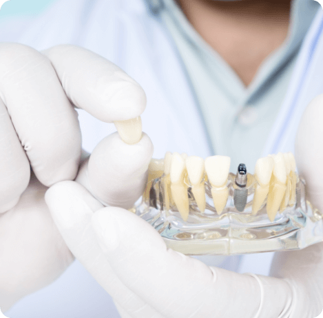 Dentist holding a dental crown and a model of the lower jaw with a dental implant