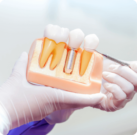 Dentist holding model of dental implant in the jaw