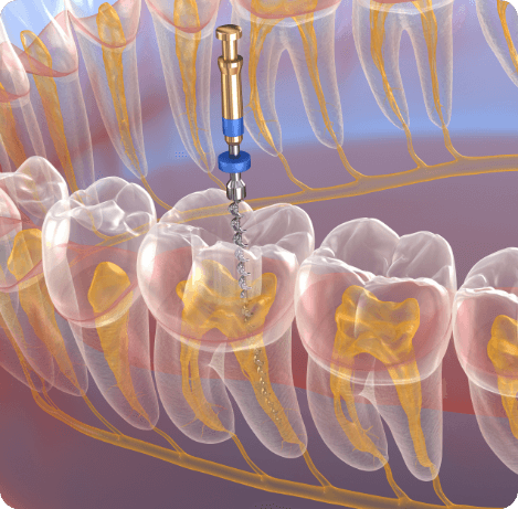 Animated dental instrument cleaning inside of tooth during root canal treatment